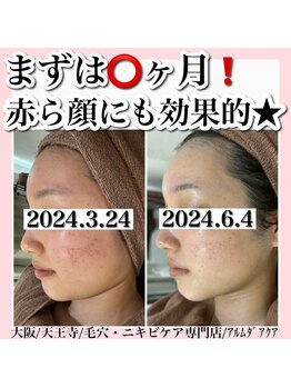 アルムダアクア 天王寺店(Aleumda AQUA)/ハーブピーリング/大阪/天王寺