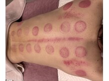 ホスピー(Hosppy)の雰囲気(カッピングも実施可能!マッサージと合わせてさらに効果もアップ)