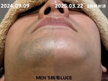 ルーチェ/【ヒゲ脱毛】2週間に1度の施術