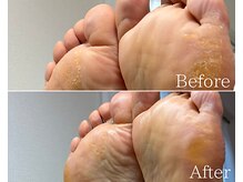 カシェット 広島店(Cachette)/50代女性☆足裏角質ケア90分