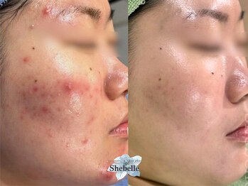 ハーブピーリング&フェイシャルサロン シーベル 福岡天神/症例写真/ハーブピーリング