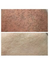 アンジェリーナ/50代/ヒゲ脱毛/10回