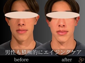 チョコバリ 恵比寿店(chocobari)/小顔リフトアップ（美容鍼）20代