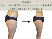 ミエル(mielu)/全身痩身　月1～2回　-10kg