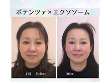 ナナイロ(nanairo)の雰囲気（マイクロニードルでエクソソームを浸透させ、瞬時にリフトアップ）