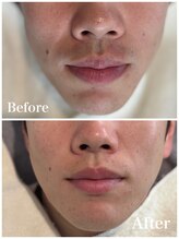 ピュア 川越店/メンズひげ脱毛