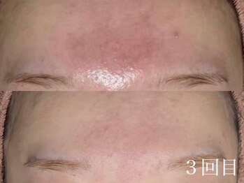 ホワイトアクア 京都店(WHITE AQUA)/ハーブピーリング/毛穴/京都