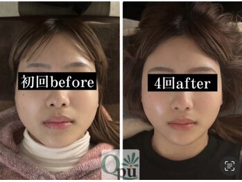 キュープ 鹿児島伊集院店(Qpu)/オイルコース4回での変化