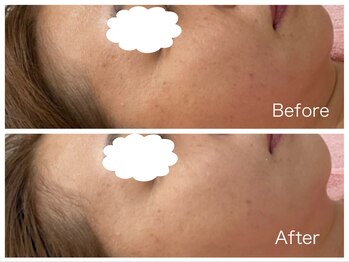 イナファー/乳酸クールピール◆美白ケア