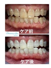 アエラ(AERA)/【テトラサイクリンの方】