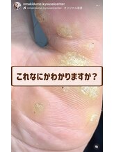 長岡巻き爪矯正センター/注意！ウイルス性イボです！