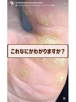 長岡巻き爪矯正センター/注意！ウイルス性イボです！
