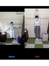 ミナト整骨院/猫背改善整体　Tさん3