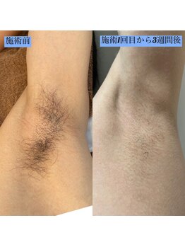 ぺルラ 島田駅前店(Perla)/メンズ脇 before after