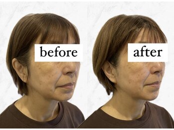 ビーアイリー(Be irie)/フェイシャルエステ直後の変化