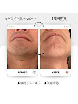 エクラ アン(eclat.un)/５０代男性：メンズヒゲ脱毛