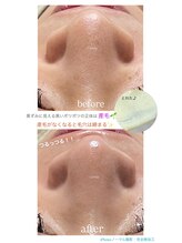 クレヴィー(Creviy)/3D毛穴洗浄×ハーブ×産毛脱毛