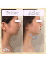 ウィズリリナ 新横浜(with Lilina.)/小顔蓄熱式超音波/1回/新横浜