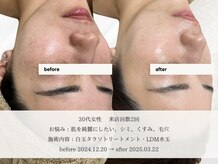 エメ 名古屋栄店(aimer)/LiftCare <小顔・リフトアップ>