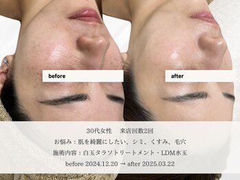 エメ 名古屋栄店(aimer)/LiftCare <小顔・リフトアップ>