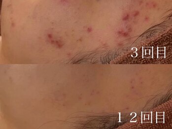 ホワイトアクア 京都店(WHITE AQUA)/ハーブピーリング/毛穴/京都