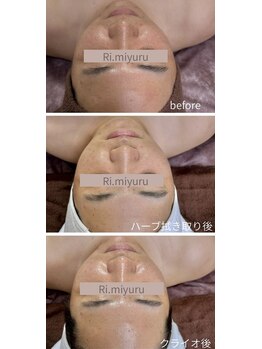 リミュール(Ri.miyuru)/ハーブピーリング+エクソソーム
