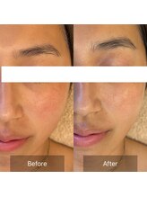 ラヴァンド(Lavande)/【ホワイトスノーピール 症例】