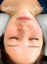 リフト 門前仲町(Lift)/小顔専門店Lift｜Before After