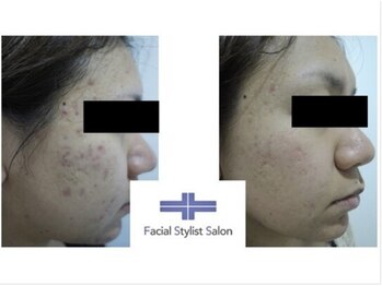 フェイシャルスタイリストサロン 四谷店/ケア例(43)