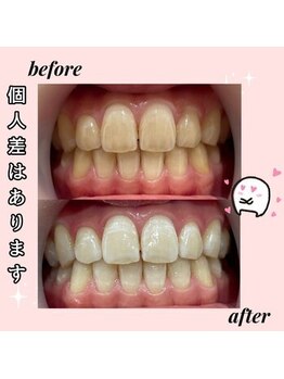 ホワイトニングカフェ 岡山店/★Before→After