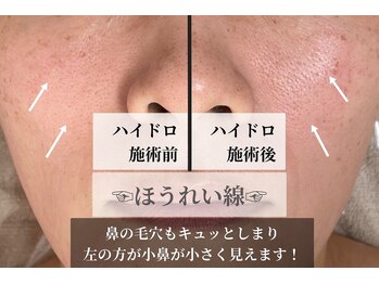 プレジール(plaisir)/毛穴ハイドロピーリング