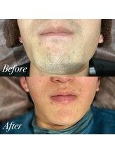 メンズ脱毛サロン ボス(BOSS)/ヒゲ脱毛で清潔感UP！＃ヒゲ脱毛