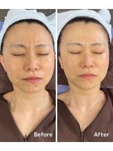 おおむら鍼灸接骨院/フェイシャル Before＆After