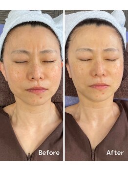 おおむら鍼灸接骨院/フェイシャル Before＆After