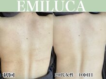 エミルカ 名古屋(EMILUCA)の雰囲気（ハーブピーリング専門店★プツプツ/背中ニキビ改善♪お肌悩み0へ）