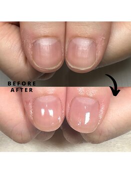 プラスワン(+1)/ハンド深爪矯正