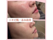 ウィズユー(with U)の雰囲気(20代のニキビ/赤みケア★3回でここまで改善)