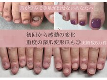 深爪矯正実績地域No.1！長年の深爪も即日見た目改善/変形爪も◎