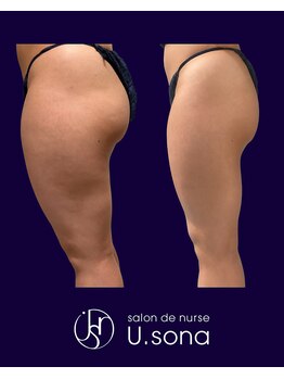 小顔・脂肪コントロール専門 salon de nurse U.sona～松本店～/【痩身】太もも脂肪分解症例