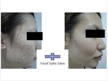 フェイシャルスタイリストサロン 四谷店/ケア例（44）