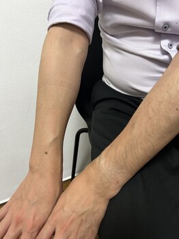 ダンニヒル(dannihil)/腕脱毛初回