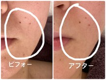 ノーブル シャット Noble Chate/大人のたるみ、ほうれい線、毛穴