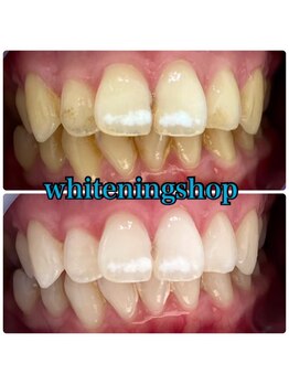 ホワイトニングショップ 山形店(Whiteningshop)/当日予約でホワイトニング