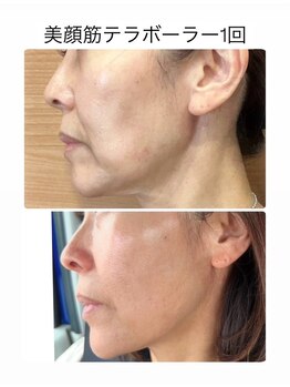 キューティ(Cutie)/テラボーラー　ビフォーアフター