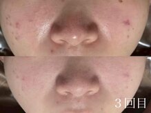 ホワイトアクア 京都店(WHITE AQUA)/ハーブピーリング/毛穴/京都