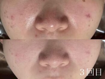 ホワイトアクア 京都店(WHITE AQUA)/ハーブピーリング/毛穴/京都