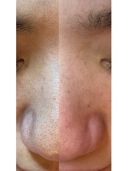 ジェリー(JERRY)/毛穴エクストラクション