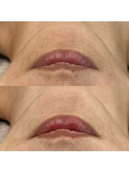 ヴェルシック(Belchic)/顎の毛穴も（50代女性のお客様）