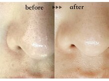 ソーヴ(SOLVE)/マツヤニワックス黒ずみ毛穴ケア