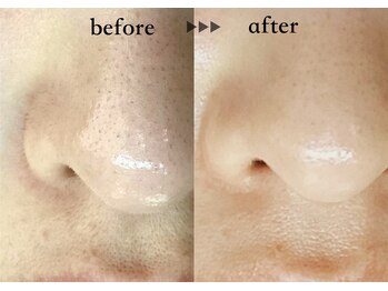 ソーヴ(SOLVE)/マツヤニワックス黒ずみ毛穴ケア